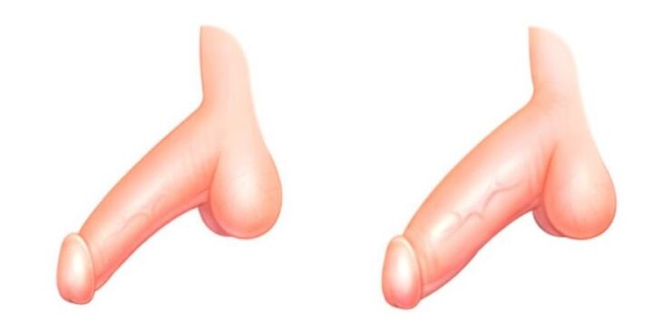penis pred a po zväčšení